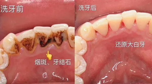 【北京21店通用丨欢乐口腔】90%人都中招口腔疾病?你该洁牙了!98元抢门市价1370元的成人洁牙+儿童口腔涂氟/窝沟封闭套餐!