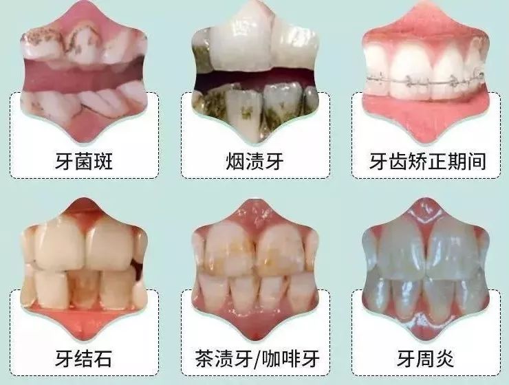 【北京21店通用丨欢乐口腔】90%人都中招口腔疾病?你该洁牙了!98元抢门市价1370元的成人洁牙+儿童口腔涂氟/窝沟封闭套餐!